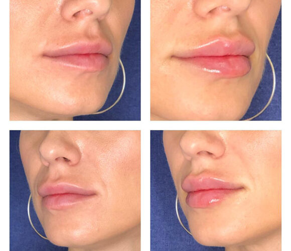 Cum sa obtii volumul dorit al buzelor cu procedura russian lips